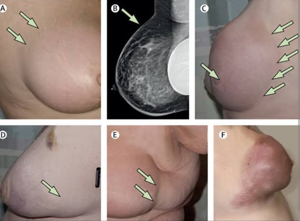 Understanding Breast Cancer: Symptoms, Diagnosis, and&nbsp;Treatment